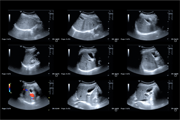 Ultrasound upper abdomen showing  Liver and gall bladder for screening hepatic cell carcinoma.